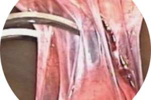 ADHERENCIAS-modified