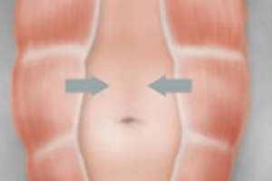 DIASTASIS DE LOS RECTOS 2
