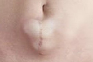 HERNIA POSTINCISIONAL