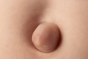 HERNIA UMBILICAL 1