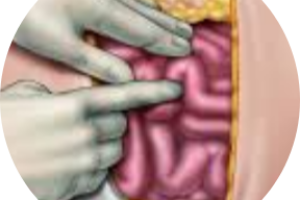 LAPAROTOMIA EXPLORADORA-modified