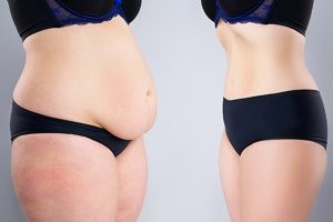 img-Abdominoplastia-15-dias-despues-resultados-y-cuidados